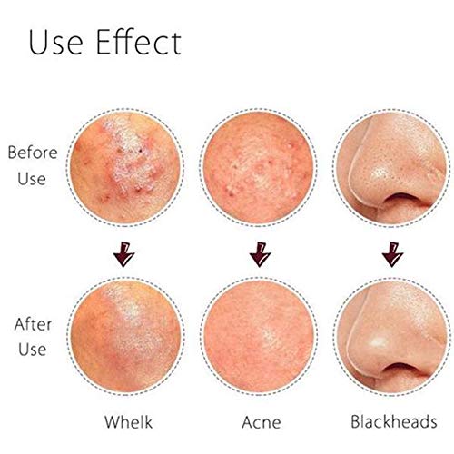 Feita - Juego de herramientas para eliminar puntos negros - Pinzas para acné, granos, etc.