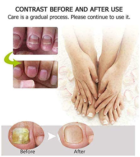FONGDY Nagelreparaturcreme Onychomykose-Reparaturcreme,Suavizante De UñAs De Los Pies, SolucióN para UñAs Duras, Gruesas Y Agrietadas, Repara (2pcs) (5pcs)
