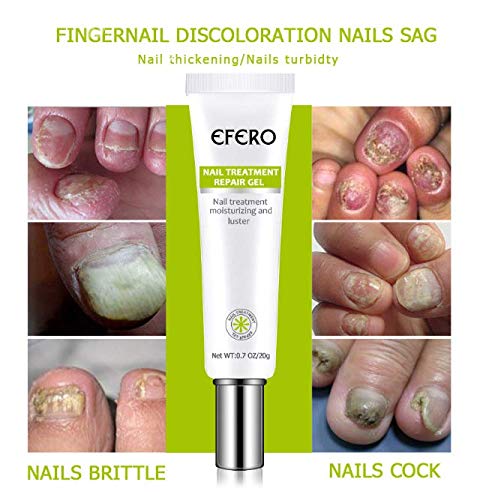 FONGDY Nagelreparaturcreme Onychomykose-Reparaturcreme,Suavizante De UñAs De Los Pies, SolucióN para UñAs Duras, Gruesas Y Agrietadas, Repara (2pcs) (5pcs)