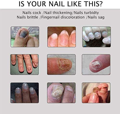 FONGDY Nagelreparaturcreme Onychomykose-Reparaturcreme,Suavizante De UñAs De Los Pies, SolucióN para UñAs Duras, Gruesas Y Agrietadas, Repara (2pcs) (5pcs)