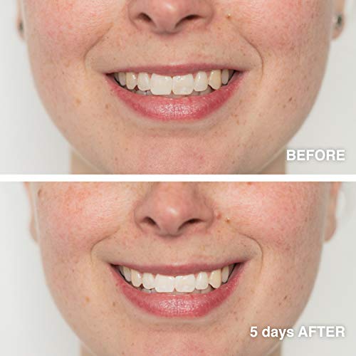 Gel Blanqueador Dental Profesional Kit de Blanqueamiento de Dientes MEAWHITE Refill Teeth Whitening