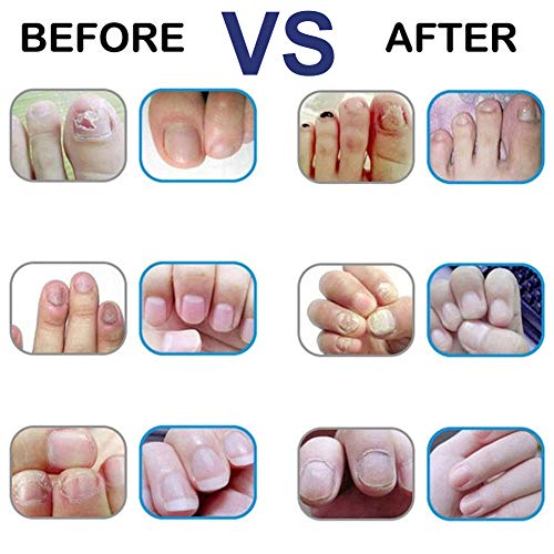 Hongos Uñas Pies,Antihongos Uñas,Nail Fungus,Tratamiento de Hongos Uñas y Pies,Rápido y Eficaz, Antibacteriano, Antiséptico y desinfectante