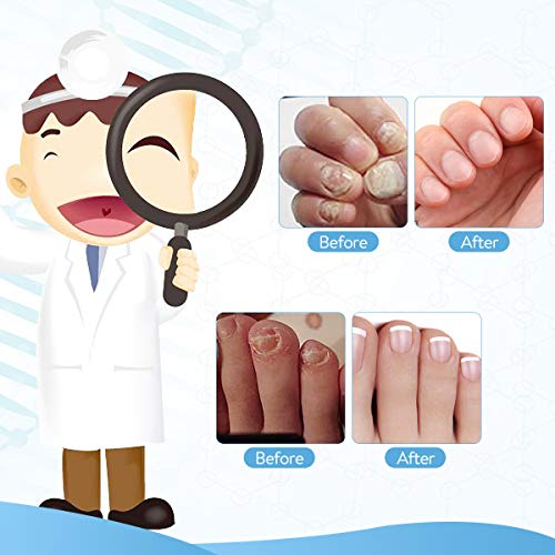 Janolia Tratamiento de Uñas, Pluma de Reparación de Uñas & Lima de Uñas, Solucionar los Onicomicosis, Reparar Las Uñas, Retirar Dedos Infectados Amarillos, Cuidado de Uñas Seguro y Natural