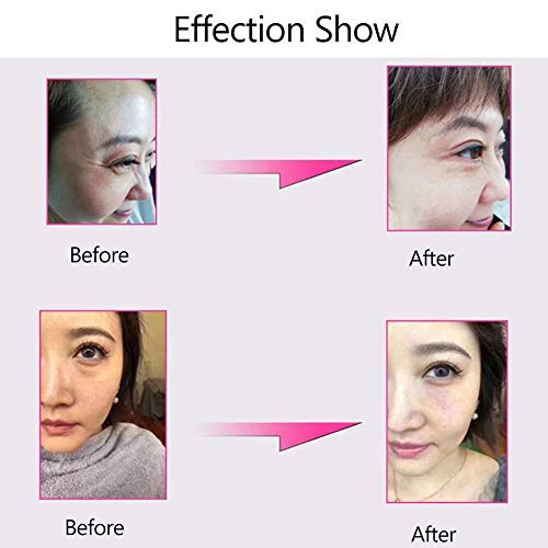 Liduzx Pluma de inyección hialurónica de 0,3 ml/0,5 ml, microinyector de ácido hialurónico, antienvejecimiento, herramienta de belleza para el cuidado de la piel