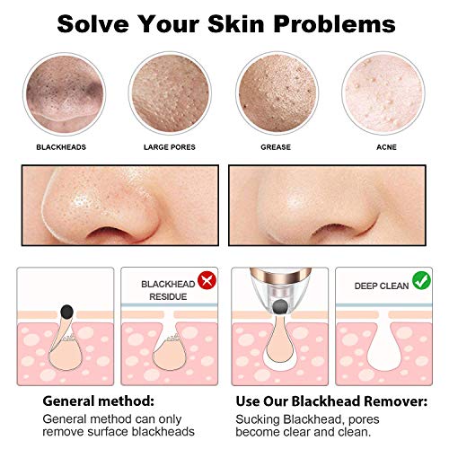 Limpiador de Poros 5-In-1 Succionador de Puntos Negros Quita Espinillas y Puntos Negros con USB Quita Puntos Negros Eliminación de Espinillas y Acné (1)