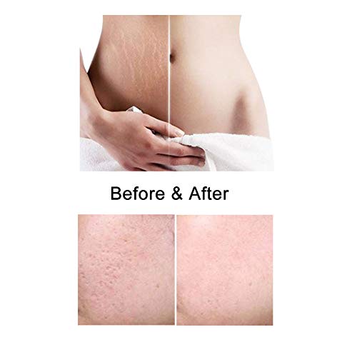 LUOLLOVE Dermaroller 1mm Titanio 540 Micro Rodillo Agujas para Cuidado de la Piel,Anti Arrugas,Eliminación de Cicatrices,Estrías,Tratamiento de Celulitis