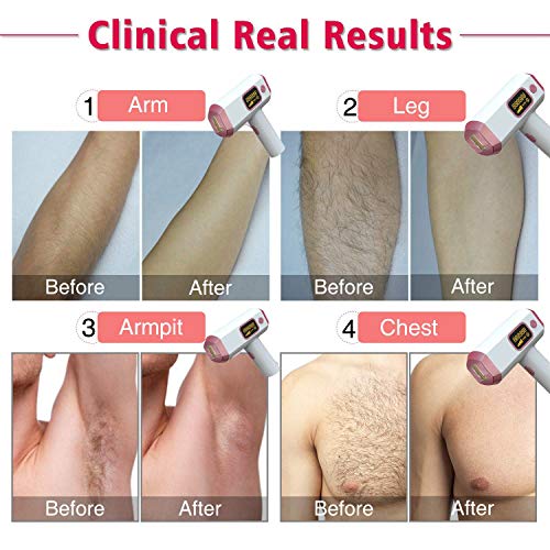 Nrpfell DepilacióN Permanente, 990, Flashes DepilacióN IPL para LíNea de Bikini de Cuerpo Completo, Pierna, Brazo, Axila-Enchufe de la UE