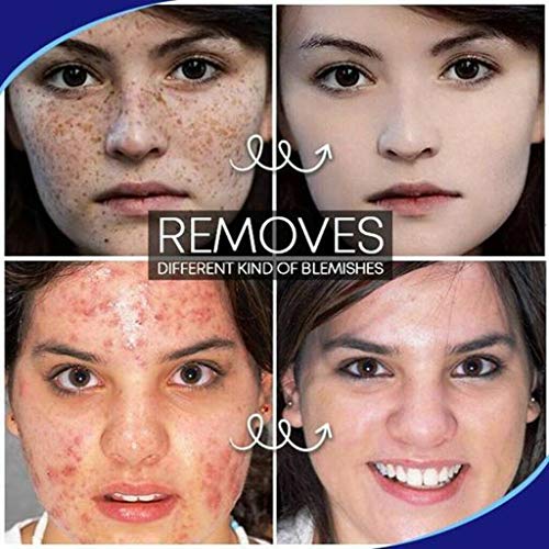 Pro.W Blemish Cream Skin Repair Ungüento Reduce el acné quístico, granos, manchas y cicatrices en la cara, espalda, cuerpo y glúteos