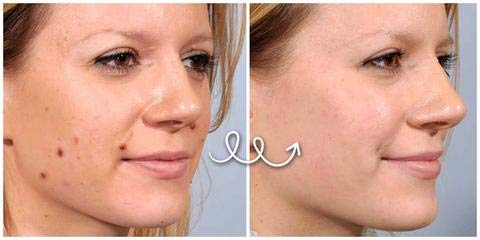 Pro.W Blemish Cream Skin Repair Ungüento Reduce el acné quístico, granos, manchas y cicatrices en la cara, espalda, cuerpo y glúteos