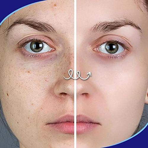 Pro.W Blemish Cream Skin Repair Ungüento Reduce el acné quístico, granos, manchas y cicatrices en la cara, espalda, cuerpo y glúteos