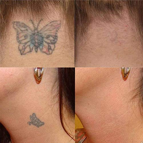 RISTHY Crema de Eliminación de Tatuajes - para Eliminar Tatuajes Que No Queremos - Crema para Borrar Tatuajes De Forma Efectiva, Segura E Indolora - Ocultar Tatuajes De Forma Segura