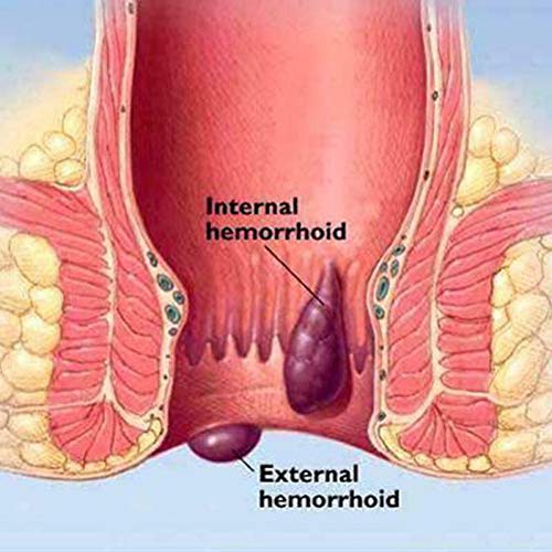 RJVCANERS Crema para Aliviar Las Hemorroides a Base de Hierbas Chinas Tratamiento Rápido para Hemorroides Externas para el Alivio del Dolor Interno y Externo de Las para Hemorroides