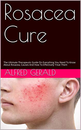Rosacea Cure: The Ultimate Therapeutic Guide On Everything You Need To Know About Rosacea, Causes And How To Effectively Treat Them (English Edition)