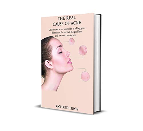 The Real Cause Of Acne: Understand what your skin is telling you. Eliminate the root of the problem and set your beauty free! (English Edition)