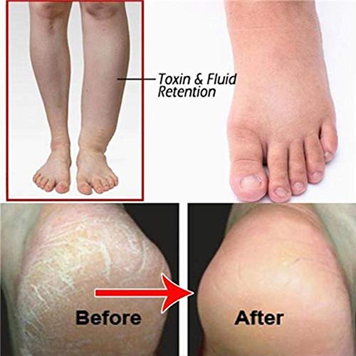 Tratamiento De Tabletas Efervescentes De Remojo De Pies De Jengibre Anti-hinchazón De 6 Piezas