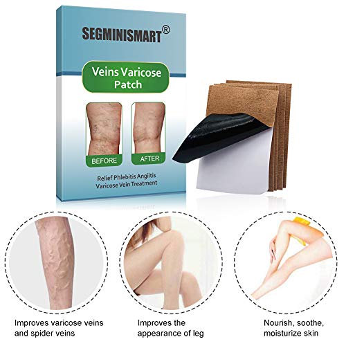 Venas Varicosas,Varicose Vein Treatment,Alivio rápido de Varices,Mejora la circulación sanguínea en las piernas,alivio de flebitis, angiitis, inflamación de vasos sanguíneos