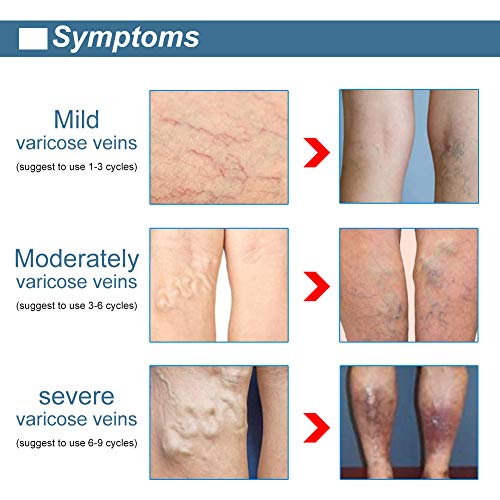 Venas Varicosas,Varicose Vein Treatment,Alivio rápido de Varices,Mejora la circulación sanguínea en las piernas,alivio de flebitis, angiitis, inflamación de vasos sanguíneos