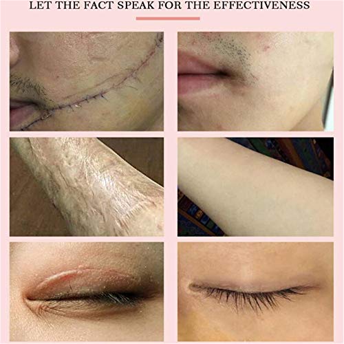 ZGBQ Crema removedora de Marcas de Estiramiento de Cicatrices de acné Crema Facial reparadora Cuidado de la Piel Aclarar, Crema reparadora de Cicatrices de Lavanda (1 Pieza)