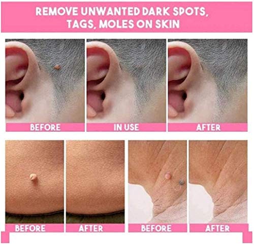 2 Pcs Solución de eliminación de etiquetas de lunares y piel Piel de lunares indoloras Eliminación de manchas oscuras Etiqueta de verrugas faciales Crema de eliminación de pecas Yeso de aceite 20 ml