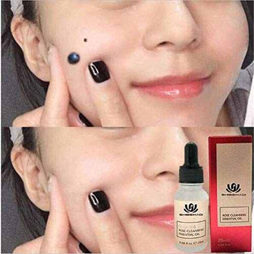 2 Pcs Solución de eliminación de etiquetas de lunares y piel Piel de lunares indoloras Eliminación de manchas oscuras Etiqueta de verrugas faciales Crema de eliminación de pecas Yeso de aceite 20 ml