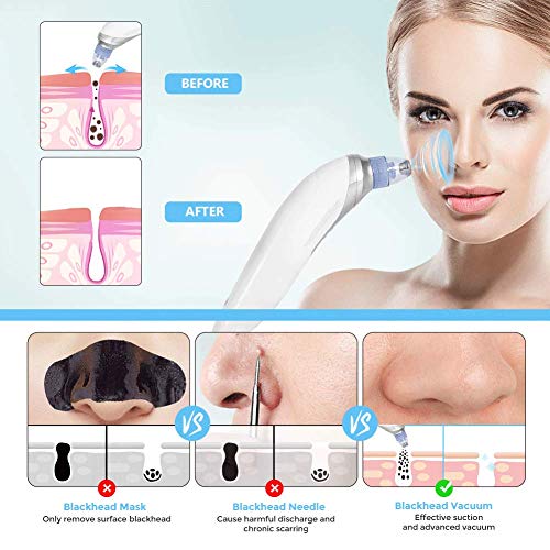 4-IN-1 Limpiador de Poros, Facial Electrico Removedor de Espinillas y Extractor Punto Negros, Quitar Puntos Negros 4 succión con USB Carga Portátil Eliminador de Espinillas y Acné