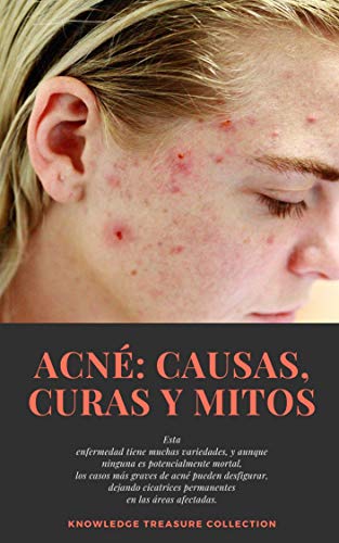 Acné: Causas, Curas y Mitos