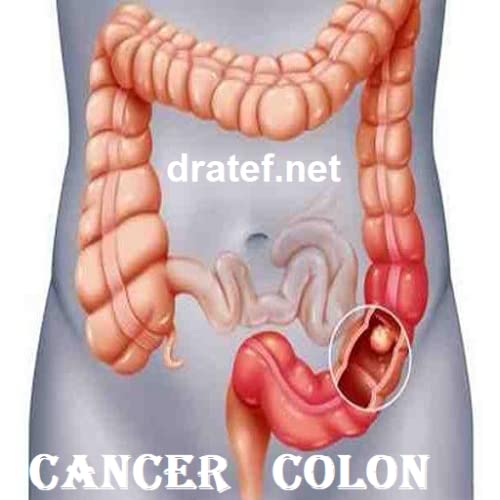 Colon Cancer