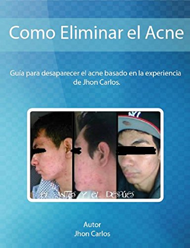 Como Eliminar el Acne basado en la Experiencia de Jhon Carlos: Guia para desaparecer el acne y sus secuelas con metodos naturales