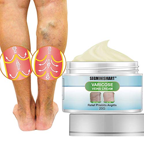 Crema para venas varicosas,Alivio de crema para venas varicosas,Crema de Venas Varicosas Crema Calmante para Piernas,Tratamiento de Venas de Araña para Piernas