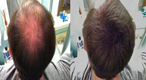 Fibras espesantes para el cabello LUXE con queratina natural - ¡Tratamiento para 2 meses! - Probado por dermatólogos - Hipoalergénico - Multiples colores disponibles. Negro