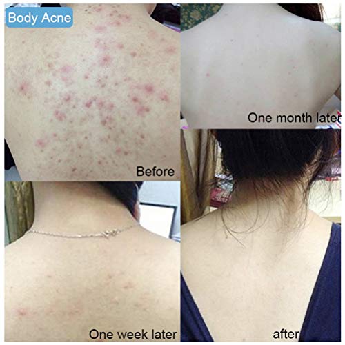 FuYouTa Jabón de sal marina Jabón para el acné, jabón de sal marina, jabón natural hecho a mano, jabón facial, aceites para el control del jabón facial, para el eccema del acné