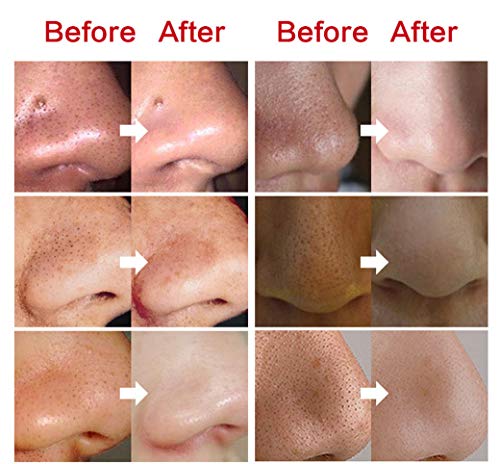 Herramienta de eliminación de espinillas Máscara de espinillas, eliminar las espinillas de la nariz, profesional Minimizar los poros Nariz Vacío Limpieza profunda Nariz （12PCS）