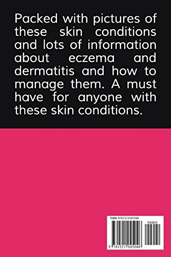 How to get Rid of and Control Eczema: Your guide to controlling your Eczema, by understanding and acting upon the root causes of this skin condition