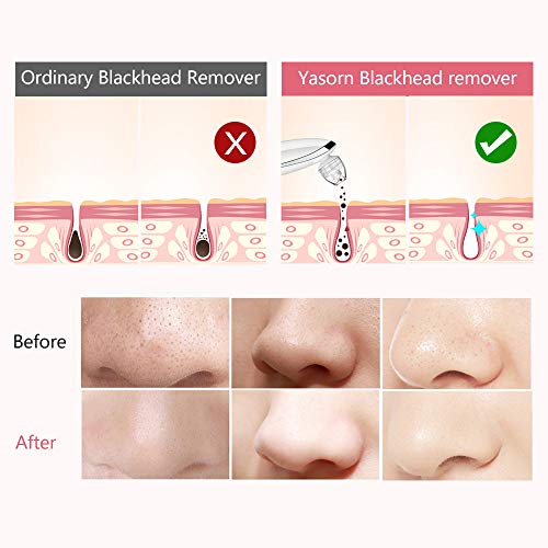 Limpiador de Poros,Extractor de Puntos Negros Eliminador De Espinillas y Acné Aspiradora Facial Limpiador Facial Electrico Succionador al vacio de Quita Puntos Negros y Espinillas Remover con 4 sondas