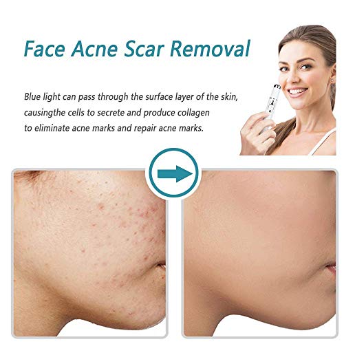 MWbetsy Bolígrafo láser para piernas, capilares, Manchas faciales, Tratamiento de Terapia de luz Azul, bolígrafo para el acné para Varices, tratamientos hormonales para el acné- A