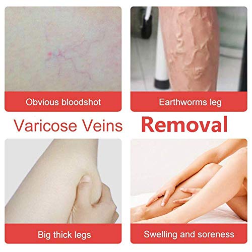 MWbetsy Bolígrafo láser para piernas, capilares, Manchas faciales, Tratamiento de Terapia de luz Azul, bolígrafo para el acné para Varices, tratamientos hormonales para el acné- A