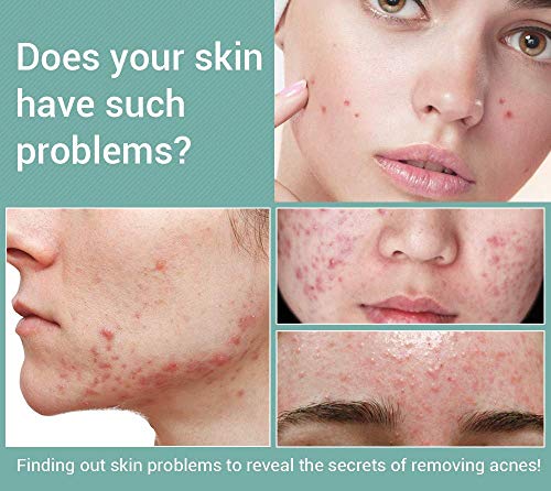 MWbetsy Bolígrafo láser para piernas, capilares, Manchas faciales, Tratamiento de Terapia de luz Azul, bolígrafo para el acné para Varices, tratamientos hormonales para el acné- A