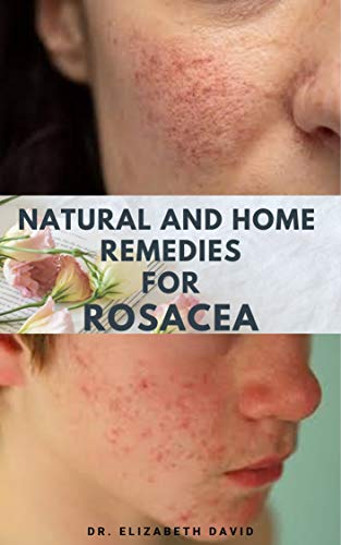 NATURAL AND HOME REMEDIES FOR ROSACEA: A Self Help Guide To Completely Prevent and Treat Rosacea (English Edition)