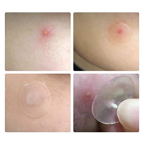 Parche de espinilla de acné pegatinas de acné invisibles tratamiento de - Pack: uso diario