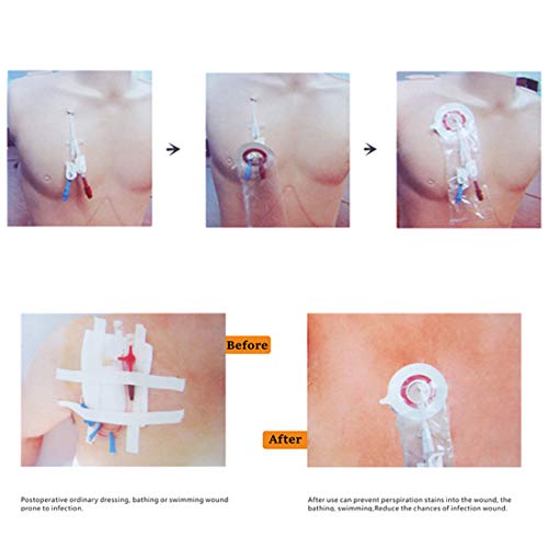 Protector de ducha impermeable de línea PICC, cubierta de protección de catéter, cubierta de ducha de barrera de humedad para apósito para heridas (2 paquetes)