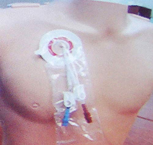 Protector de ducha impermeable de línea PICC, cubierta de protección de catéter, cubierta de ducha de barrera de humedad para apósito para heridas (2 paquetes)