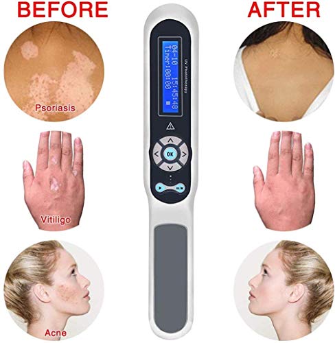 Qwhone De Mano fototerapia UVB Fototerapia en el hogar de la lámpara Fluorescente con Pantalla LCD de Control Temporizador Digital con los anteojos