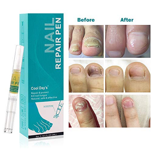 Reparar Las Uñas,Tratamiento de Uñas,Pluma de Reparación de Uñas,Reparar Las Uñas,solución antihongos para uñas de los pies y uñas de los pies, 4PC