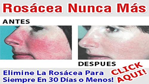 Rosácea.Rosacea Cura