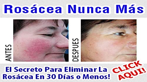 Rosácea.Rosacea Cura
