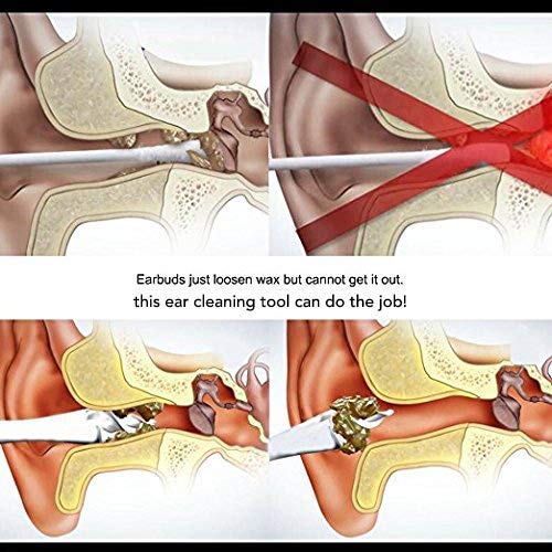 Smart Limpiador De Oidos Bastoncillos Oidos Limpieza De OíDos Con 16 Punta Suave En Espiral Silicona OíDo Cera Eliminar Cerumen Segura Y Eficaz