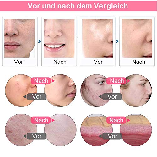 UPANV Máquina De Microdermoabrasión Diamante, Salón De Cuidado Facial Profesional Kit De Microdermoabrasión para Pelar La Piel, Rejuvenecimiento, Estiramiento, Estiramiento