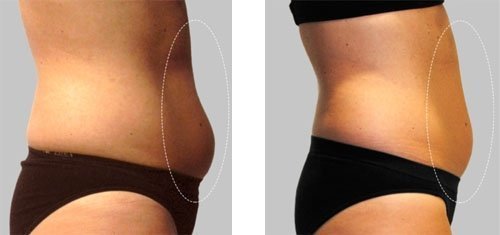 1 Wrap Adelgazante, Parche Reductor Corporal, Body Wrap Applicator