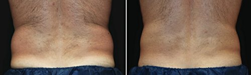 2 Wraps Adelgazante, Parche Reductor Corporal, Body Wrap Applicator