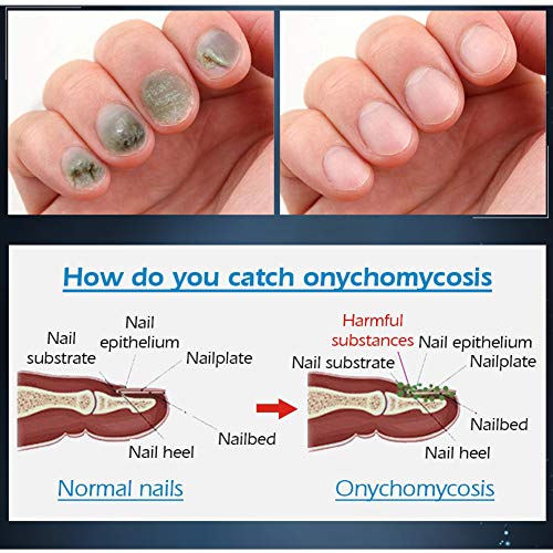 AMYGG Tratamiento de Uñas Crema Reparación de Uñas Renovar Dañado Roto Agrietado Uñas Descoloridas (2 PCS)